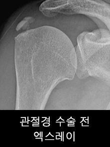 관절경 수술 전 엑스레이